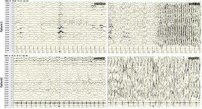 Emerging evidence of genotype–phenotype associations of developmental and epileptic encephalopathy due to KCNC2 mutation: Identification of novel R405G